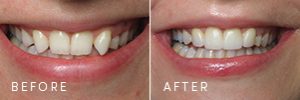 A before and after of a patient with missing lateral teeth and prominent, fang-like cuspids treated with cosmetic dentistry and new porcelain crowns.