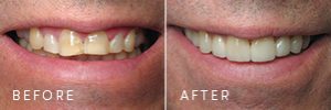 A patient with wear and discoloration on their teeth before and after porcelain restoration from cosmetic dentistry.
