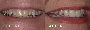 A patient before and after new porcelain crowns.