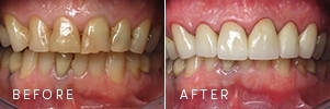 A patient with teeth discoloration before and after dentistry procedures to improve dental health.