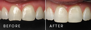 A patient with a broken edge on their teeth before and after it’s repaired with cosmetic dentistry.