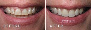 A patient with worn teeth before and after porcelain veneers were used to create a younger, healthier smile.