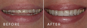 A patient with flat tooth edges and a worn smile before and after cosmetic dentistry restored the length and curve of the smile.