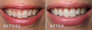 A patient with uneven gum architecture before and after porcelain veneers.