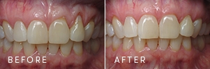 A patient with gum recession before and after periodontal and gum health improvements.