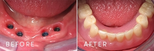 A patient during the process of dental implants.