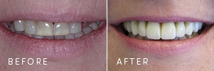 A patient with gum disease before and after dental implants.
