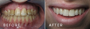 A patient before and after dental implants were restored.